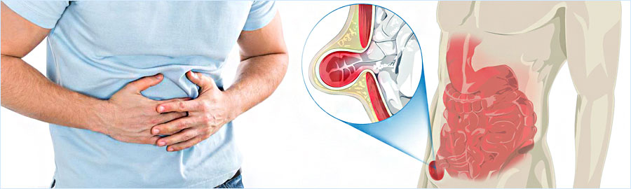 Hernia Surgery