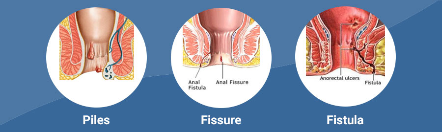 Laser Piles Surgery